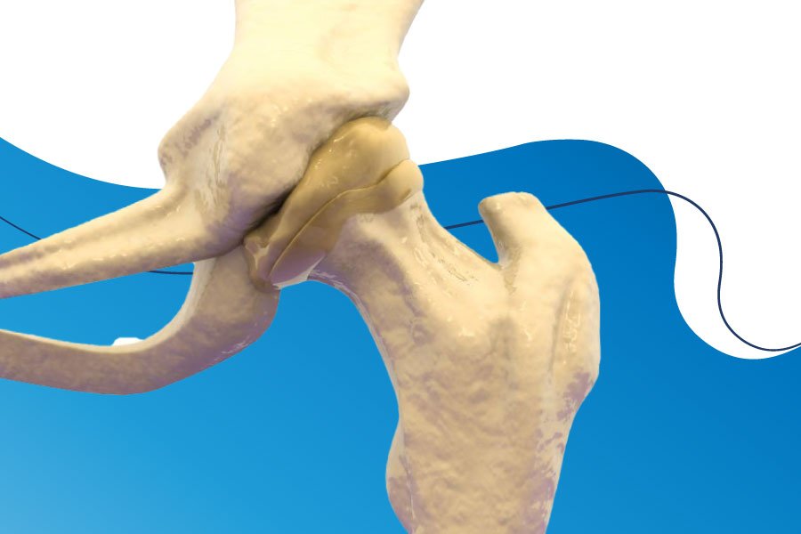 Saiba mais sobre artrose do quadril e conheça os tipos da doença